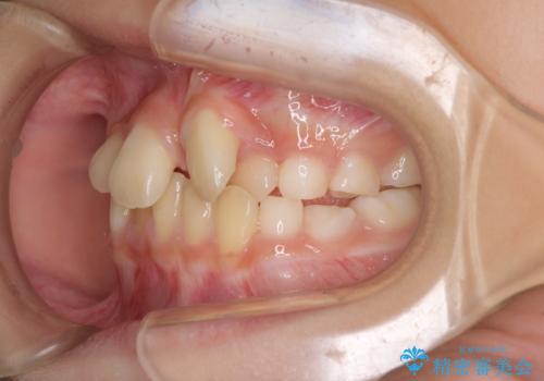 過剰歯を抜歯して前歯を排列 インビザライン・ファーストによる小学生のⅠ期治療の治療前