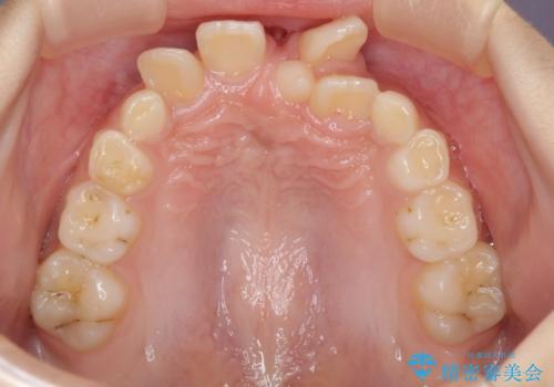 過剰歯を抜歯して前歯を排列 インビザライン・ファーストによる小学生のⅠ期治療の治療前