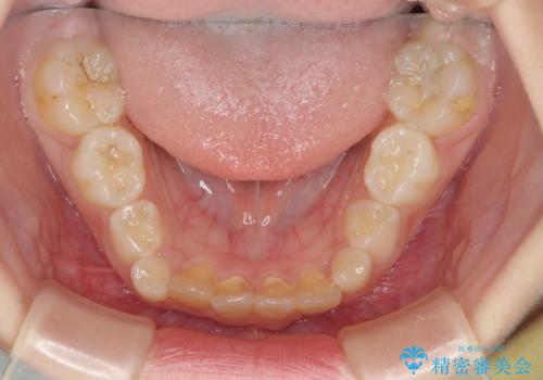 過剰歯を抜歯して前歯を排列 インビザライン・ファーストによる小学生のⅠ期治療の治療前
