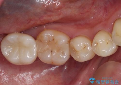 もげてしまった奥歯 部分矯正で清掃性の良い補綴治療の治療後