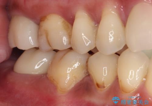 もげてしまった奥歯 部分矯正で清掃性の良い補綴治療の治療後