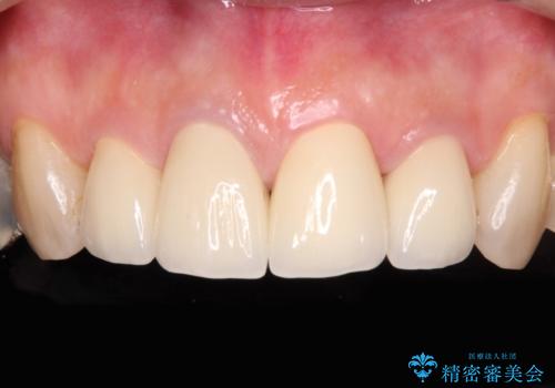 痛む奥歯と見栄えの悪い前歯 オールセラミックによる補綴治療