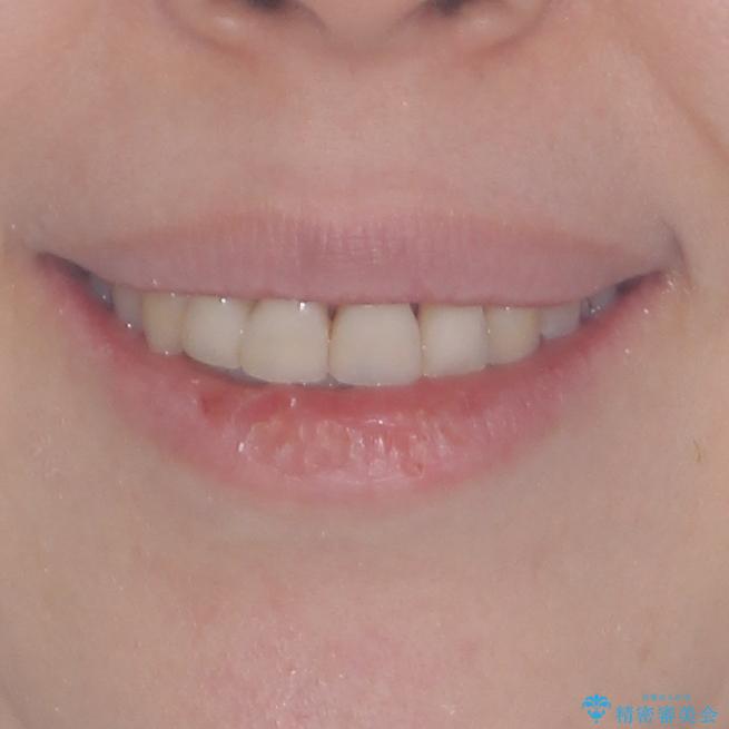 口元の出っ張りとデコボコを改善したいの治療後(顔貌)