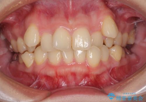 上顎の八重歯と下顎前歯の欠損　ワイヤー装置による抜歯矯正の症例 治療前