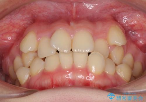 上顎の八重歯と下顎前歯の欠損 ワイヤー装置による抜歯矯正の治療前