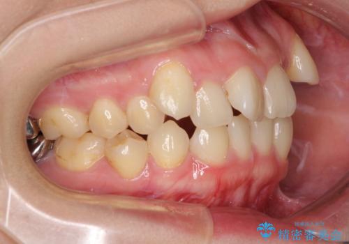 上顎の八重歯と下顎前歯の欠損 ワイヤー装置による抜歯矯正の治療前