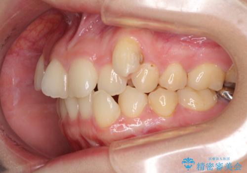 上顎の八重歯と下顎前歯の欠損 ワイヤー装置による抜歯矯正の治療前