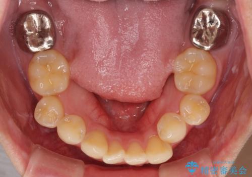 上顎の八重歯と下顎前歯の欠損 ワイヤー装置による抜歯矯正の治療前