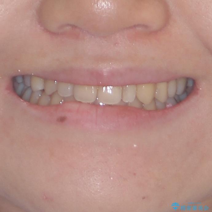 八重歯の抜歯矯正　補助装置を用いたインビザライン矯正の治療後（顔貌）