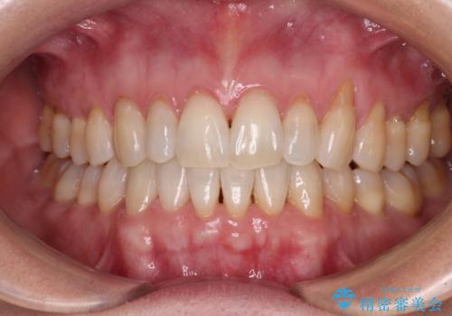 前歯のスペースが気になる　インビザラインによる矯正治療の症例 治療後