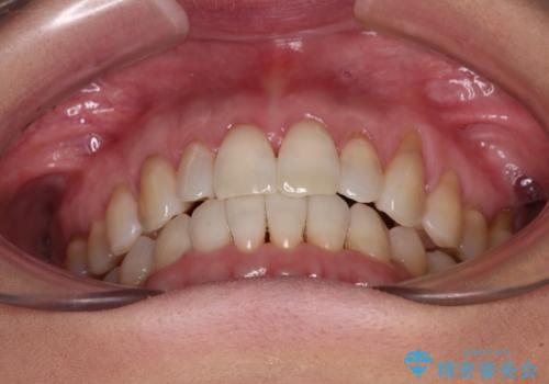前歯のスペースが気になる インビザラインによる矯正治療の治療後