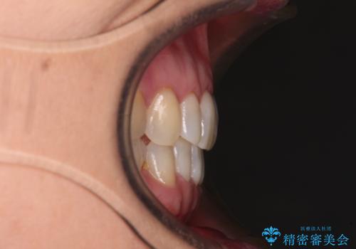 前歯のスペースが気になる インビザラインによる矯正治療の治療後