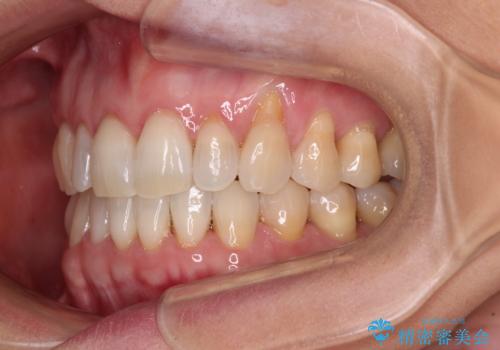 前歯のスペースが気になる インビザラインによる矯正治療の治療後