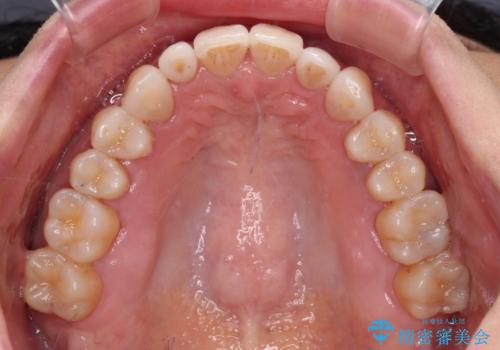 前歯のスペースが気になる インビザラインによる矯正治療の治療後