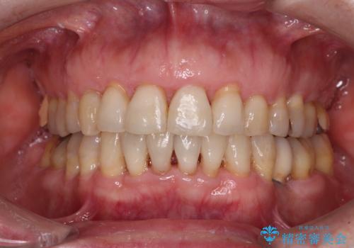 口元の出っ張りとデコボコを改善したいの治療後