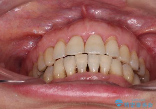 口元の出っ張りとデコボコを改善したいの治療後