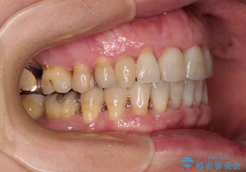 口元の出っ張りとデコボコを改善したいの治療後