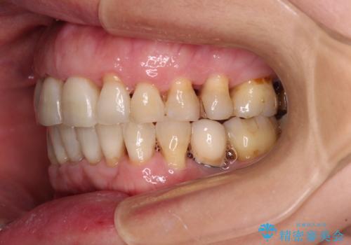 口元の出っ張りとデコボコを改善したいの治療後