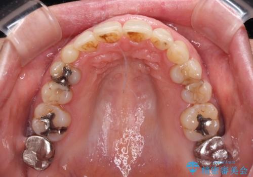 口元の出っ張りとデコボコを改善したいの治療後