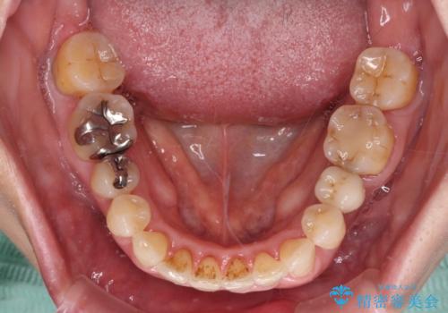 口元の出っ張りとデコボコを改善したいの治療後