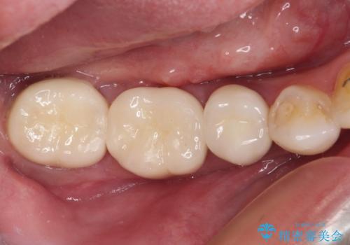 奥歯がしみる　色々な国で治療を受けてきた奥歯のむし歯治療
