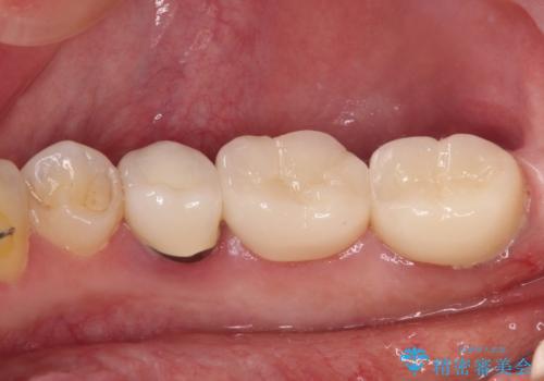 奥歯がしみる　色々な国で治療を受けてきた奥歯のむし歯治療の治療後