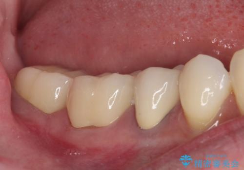 奥歯がしみる 色々な国で治療を受けてきた奥歯のむし歯治療の治療後