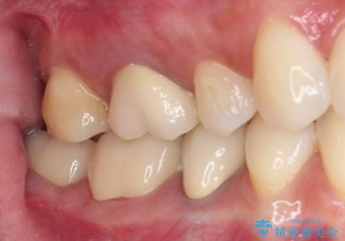 奥歯がしみる 色々な国で治療を受けてきた奥歯のむし歯治療の治療後