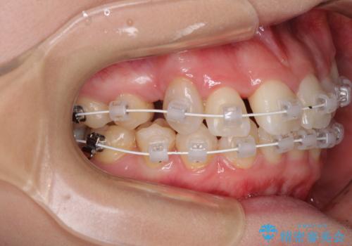 上顎の八重歯と下顎前歯の欠損 ワイヤー装置による抜歯矯正の治療中