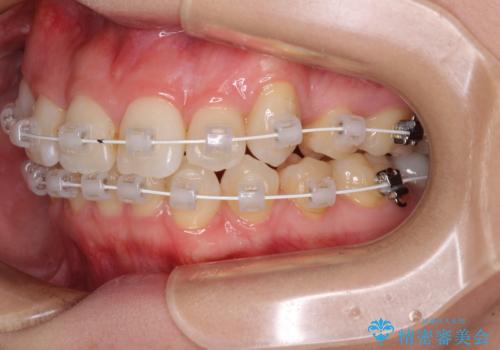 上顎の八重歯と下顎前歯の欠損 ワイヤー装置による抜歯矯正の治療中