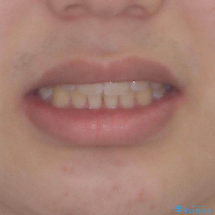 しっかり使って短期間で治療 インビザラインによる叢生解消の治療後(顔貌)