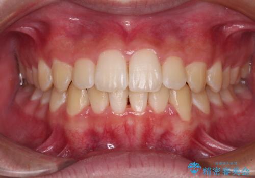 しっかり使って短期間で治療 インビザラインによる叢生解消の症例 治療後