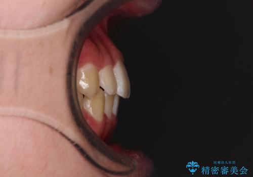 しっかり使って短期間で治療 インビザラインによる叢生解消の治療後