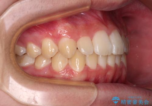 しっかり使って短期間で治療 インビザラインによる叢生解消の治療後