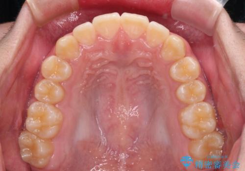 しっかり使って短期間で治療 インビザラインによる叢生解消の治療後