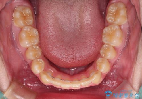 しっかり使って短期間で治療 インビザラインによる叢生解消の治療後