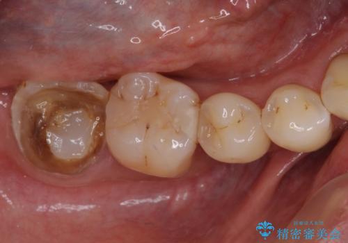 もげてしまった奥歯 部分矯正で清掃性の良い補綴治療の治療前