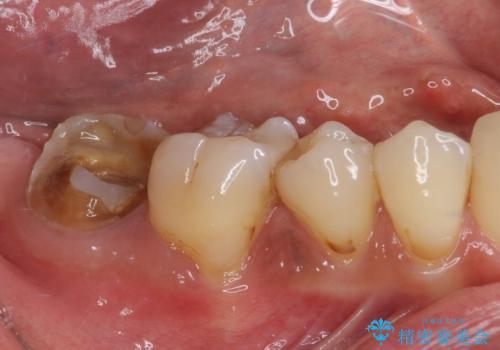 もげてしまった奥歯 部分矯正で清掃性の良い補綴治療の症例 治療前