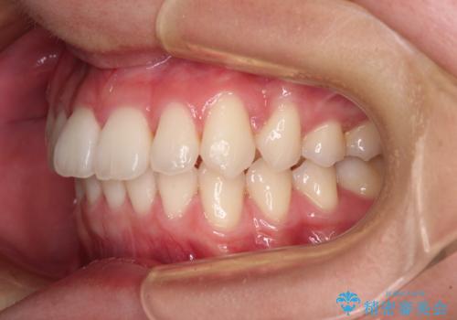 【モニター】犬歯のクロスバイトを目立たないワイヤー装置での治療後