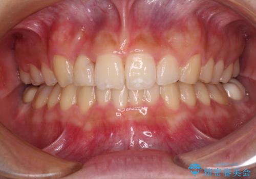 気になる八重歯を改善　補助装置併用のインビザライン治療の症例 治療後