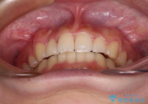 気になる八重歯を改善 補助装置併用のインビザライン治療の治療後