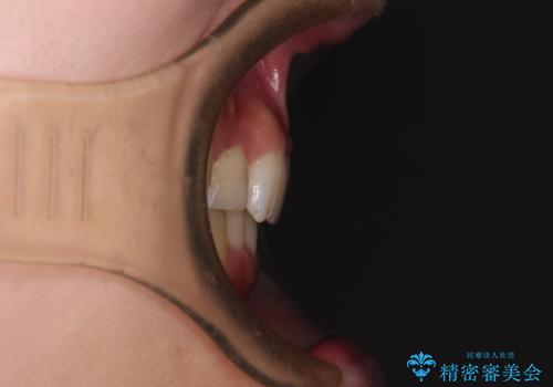 気になる八重歯を改善 補助装置併用のインビザライン治療の治療後