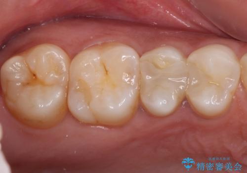 奥歯のむし歯をゴールドインレーで修復の治療前