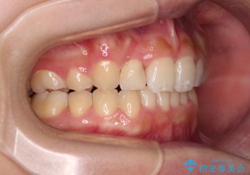 気になる八重歯を改善 補助装置併用のインビザライン治療の治療後