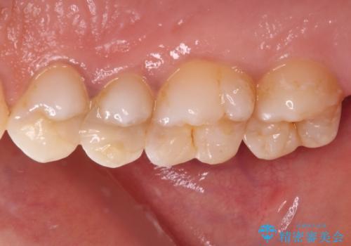 奥歯のむし歯をゴールドインレーで修復の治療前