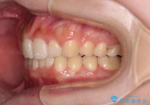 気になる八重歯を改善　補助装置併用のインビザライン治療の治療後