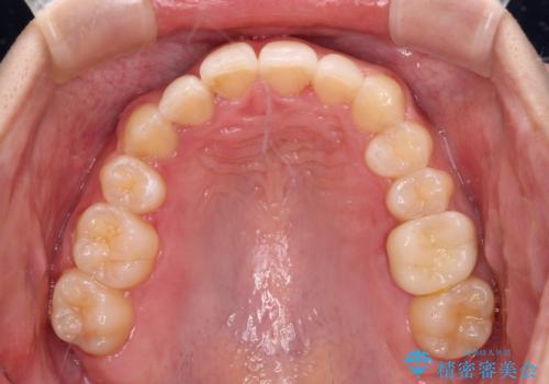 気になる八重歯を改善 補助装置併用のインビザライン治療の治療後