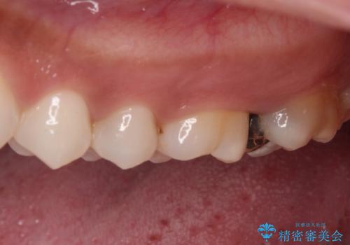 奥歯のむし歯をゴールドインレーで修復の治療前