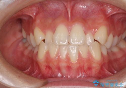 ワイヤー矯正を併用し、リスクを回避しながらのインビザライン矯正治療の症例 治療前