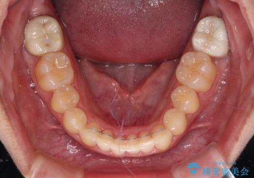 気になる八重歯を改善　補助装置併用のインビザライン治療の治療後